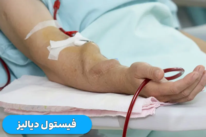 فیستول دیالیز