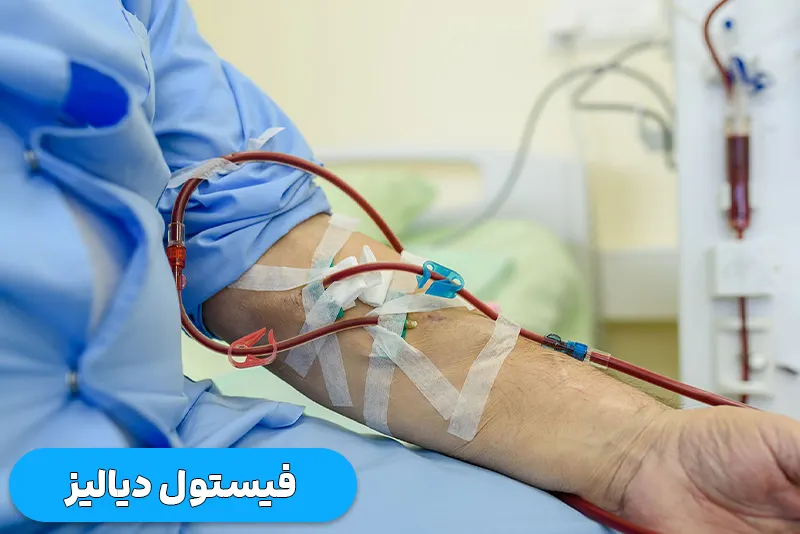 فیستول دیالیز