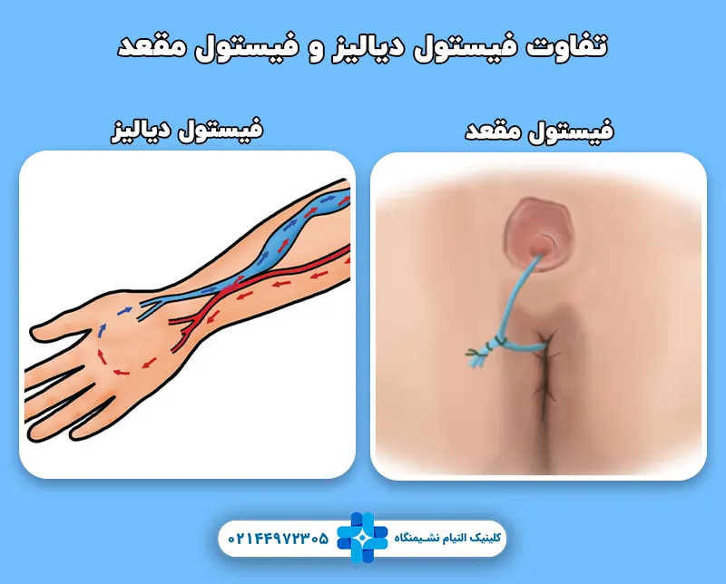 فیستول دیالیز و تفاوت آن با فیستول مقعد