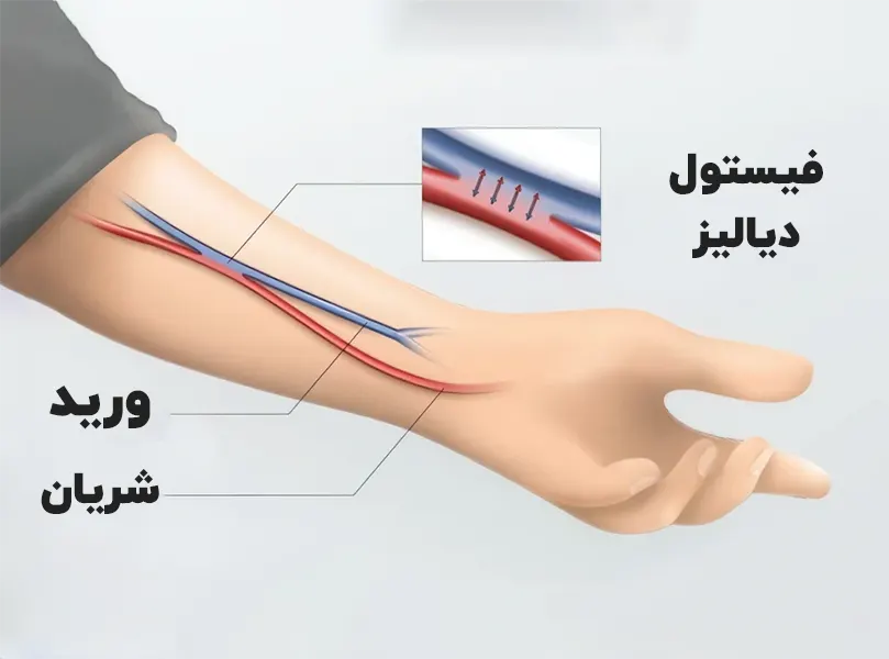 فیستول دیالیز