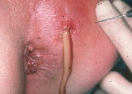 تخلیه آبسه مقعد