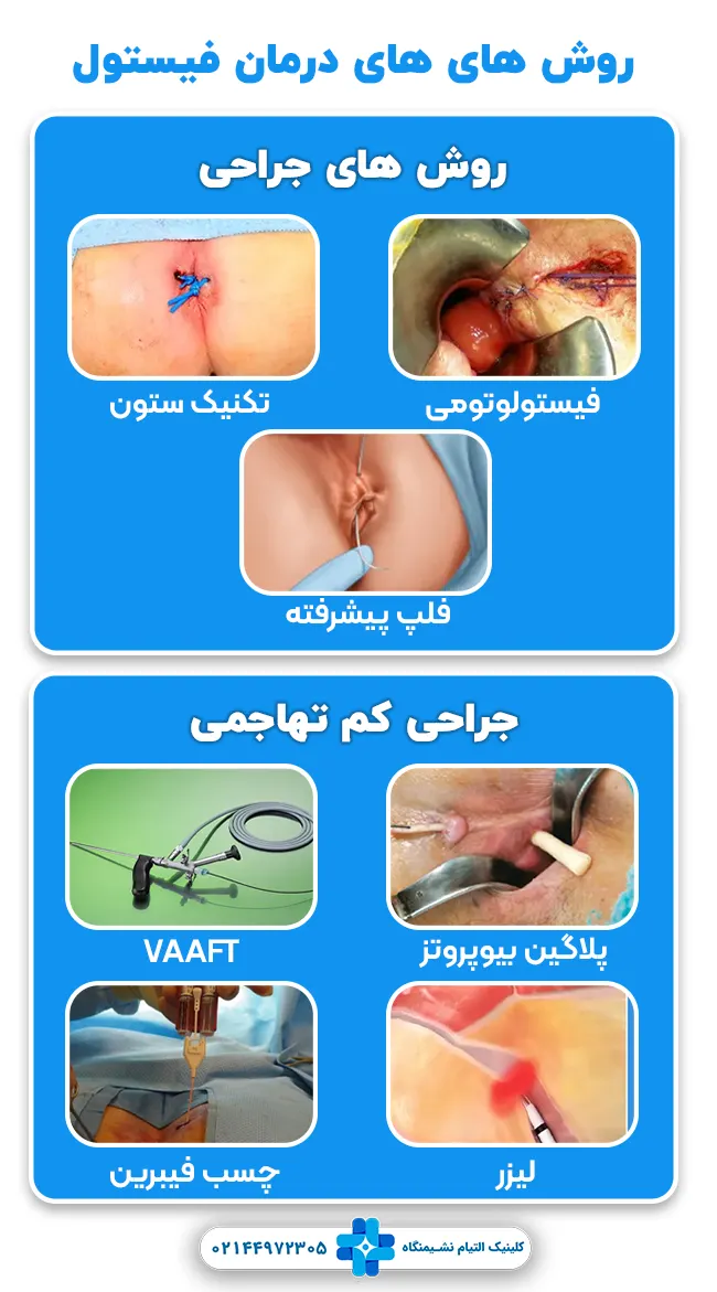 انواع روش های جراحی فیستول مقعدی