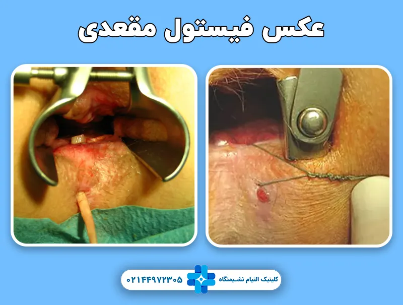 عکس فیستول مقعد