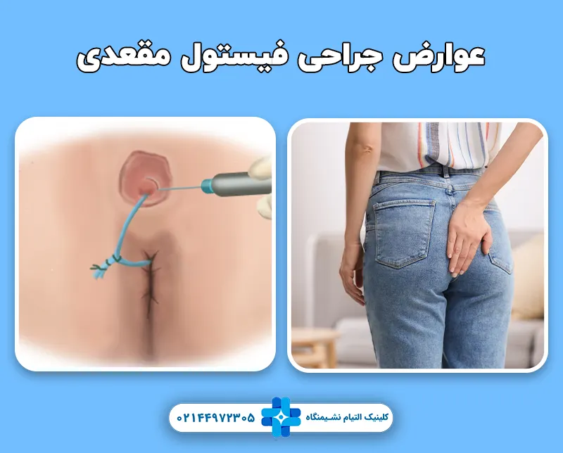 عوارض جراحی فیستول مقعدی