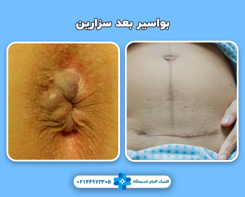 علائم هموروئید بعد از سزارین