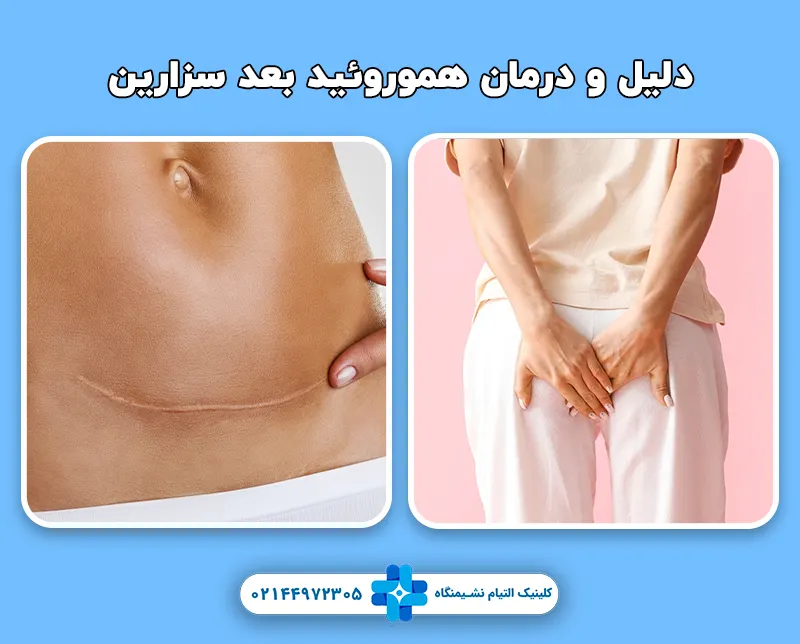 هموروئید بعد سزارین