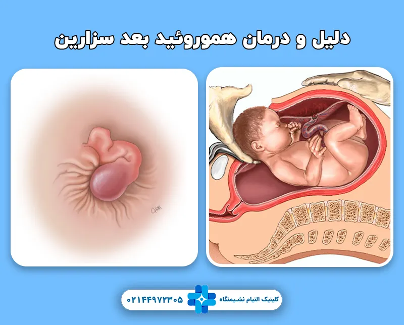 علت هموروئید پس از سزارین