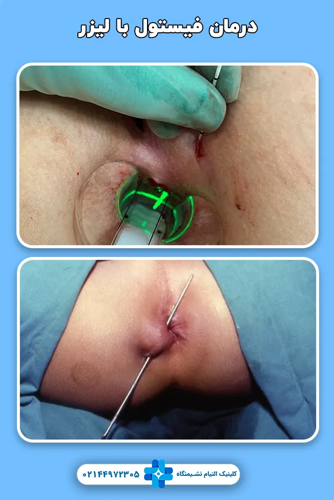 درمان فیستول با لیزر