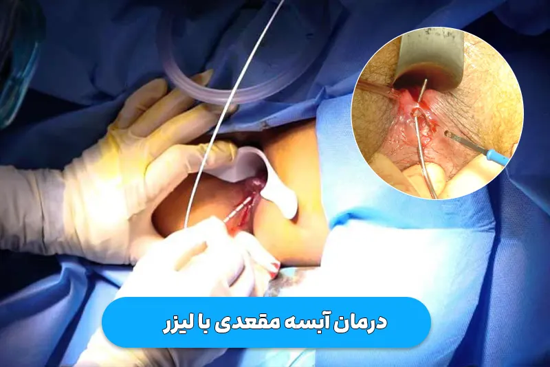 لیزر آبسه مقعدی
