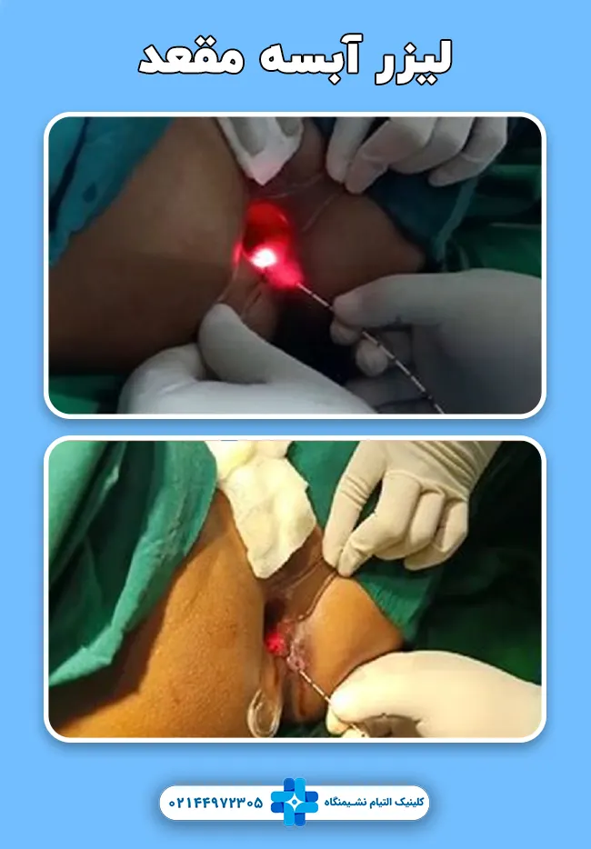 لیزر آبسه مقعدی