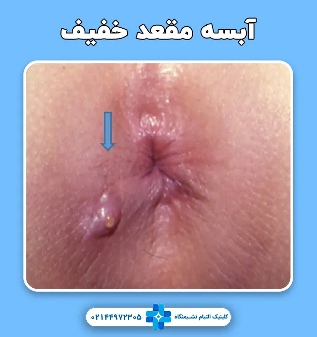 آبسه مقعدی خفیف