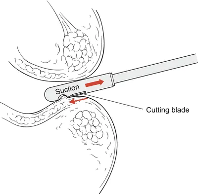 بیوپسی رکتوم
