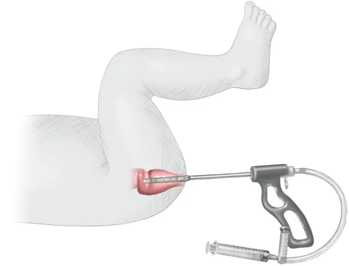 بیوپسی رکتوم