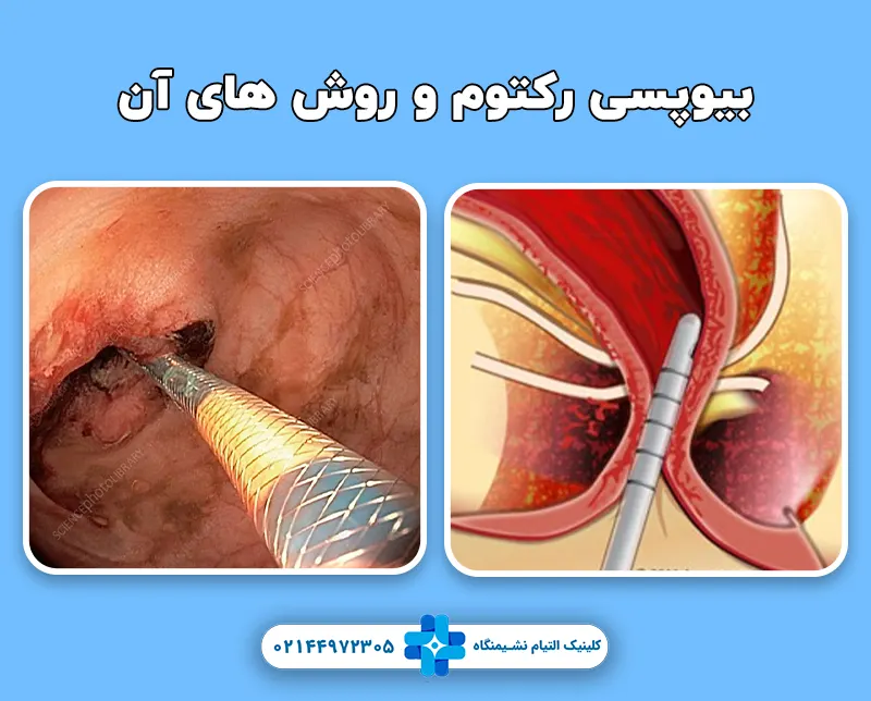 بیوپسی رکتوم