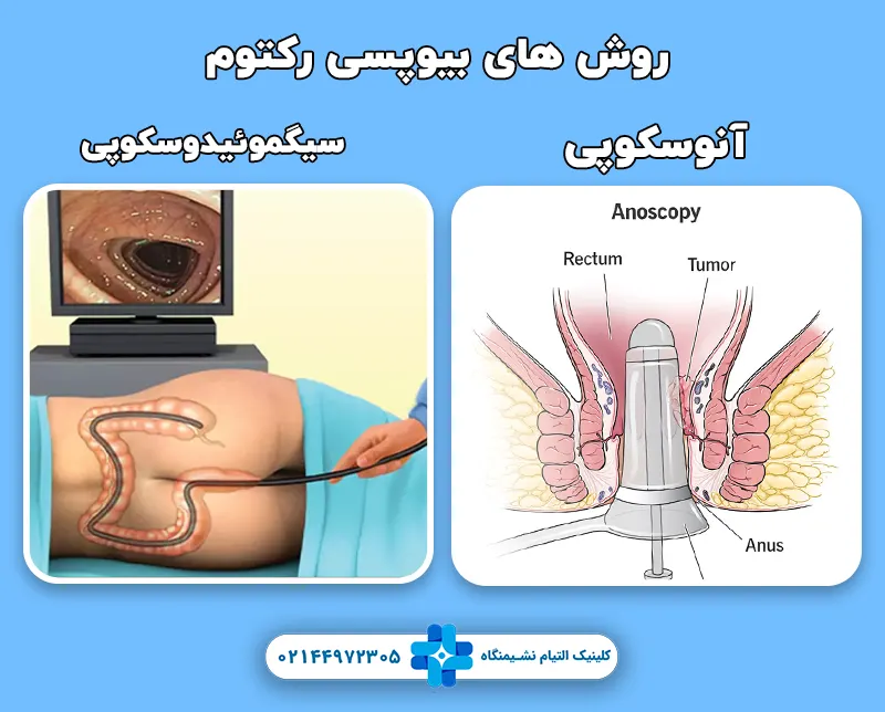 روش های بیوپسی رکتوم