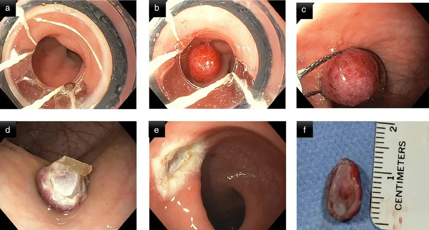 بیوپسی رکتوم