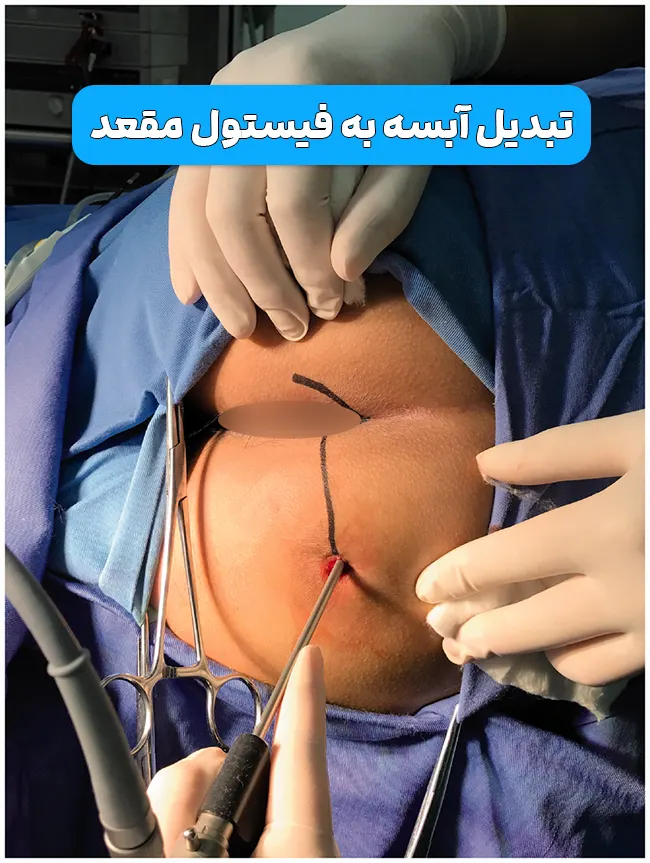 تبدیل آبسه مقعد به فیستول