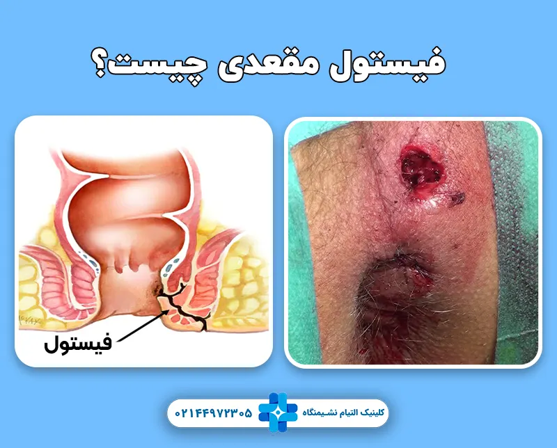فیستول چیست