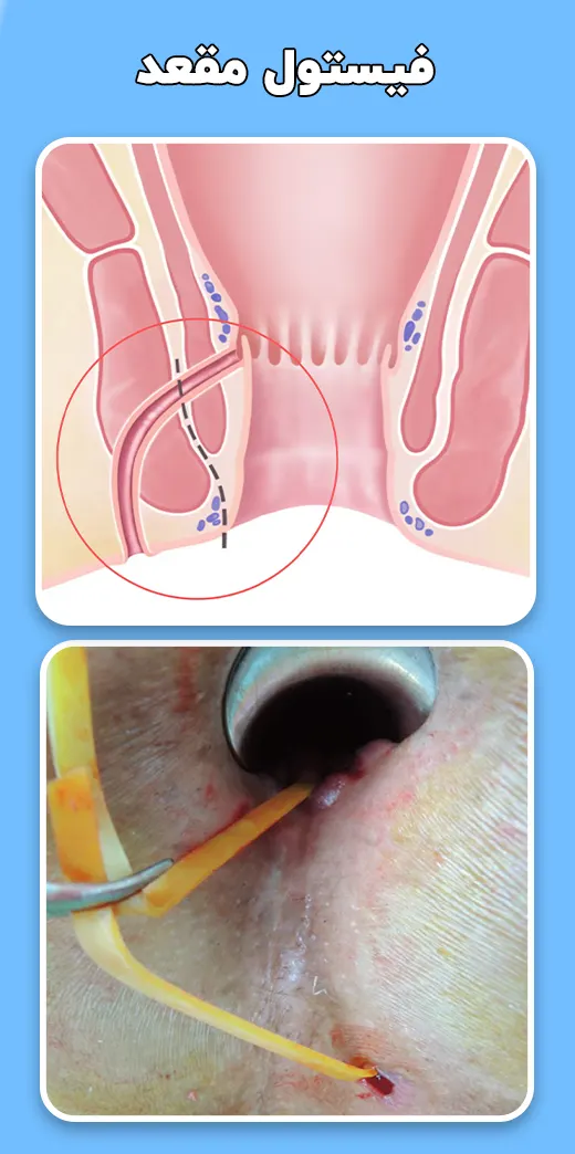 فیستول مقعد