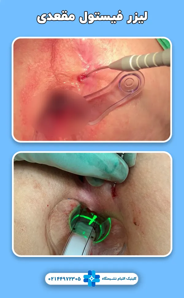 لیزر فیستول مقعد