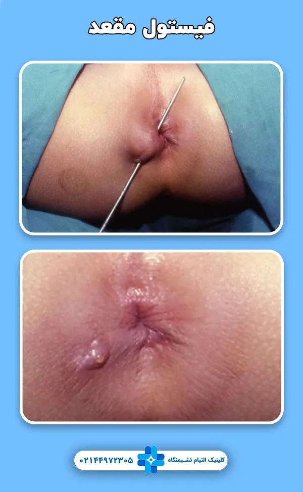 فیستول مقعد