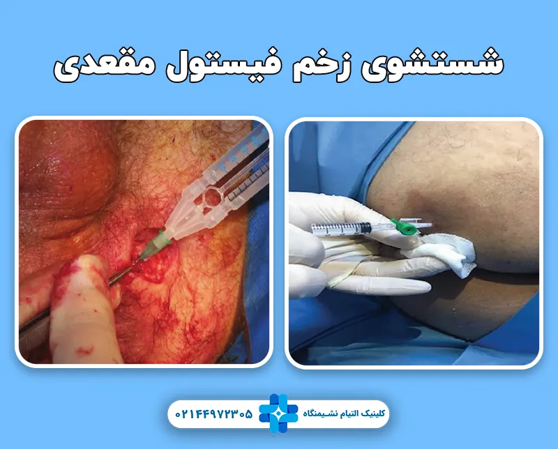 شستشوی زخم فیستول