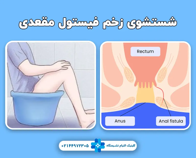 شستشوی زخم فیستول