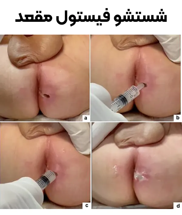 شستشوی زخم فیستول