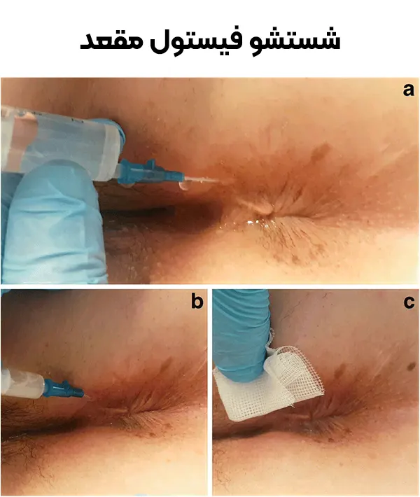 شستشوی زخم فیستول