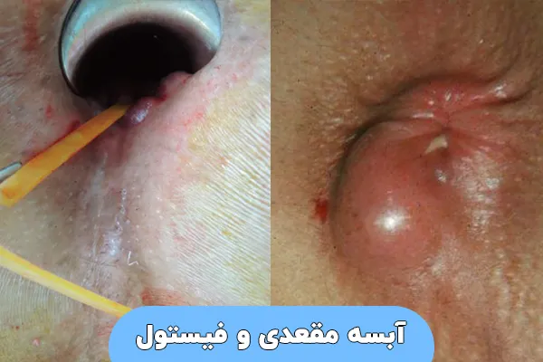 آبسه مقعدی و فیستول