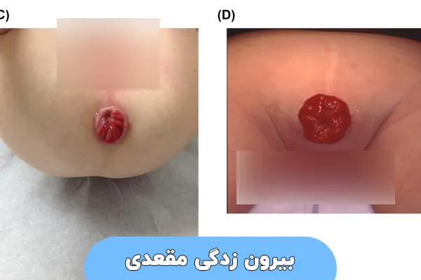 بیرون زدگی مقعدی