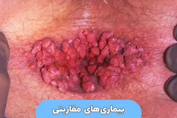 بیماری‌های مقاربتی