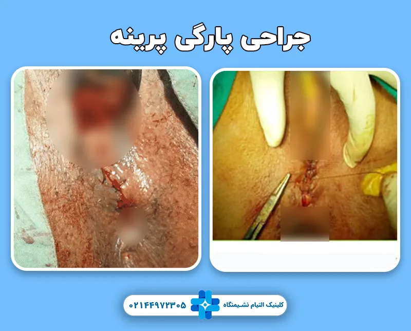 جراحی پارگی پرینه
