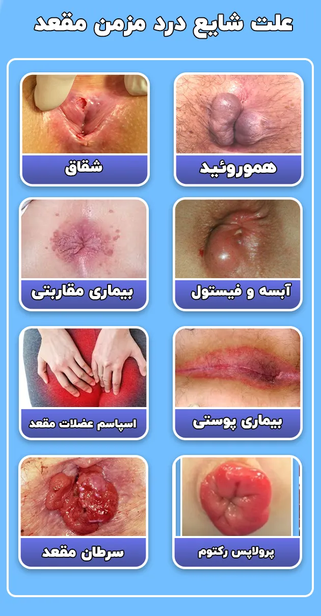 8 دلیل درد مزمن مقعد را بشناسید