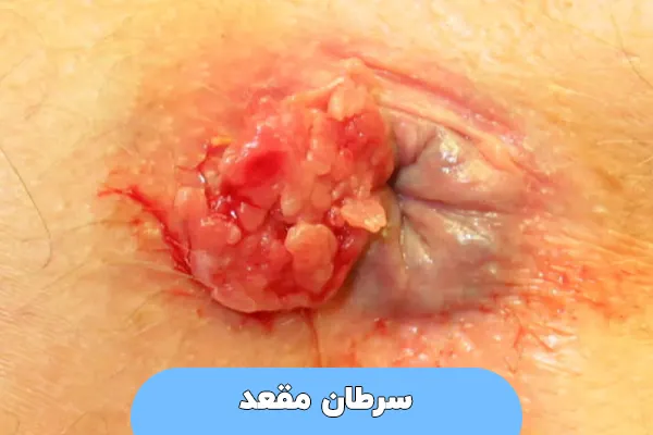 سرطان مقعد