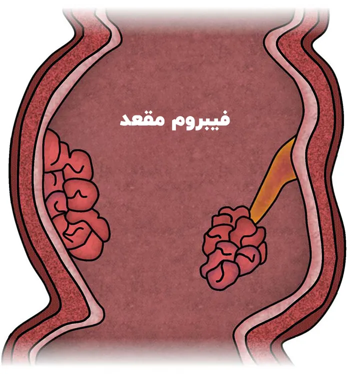 فیبروم مقعد