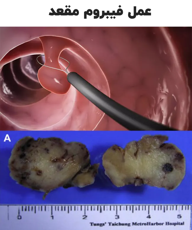 عمل فیبروم مقعد