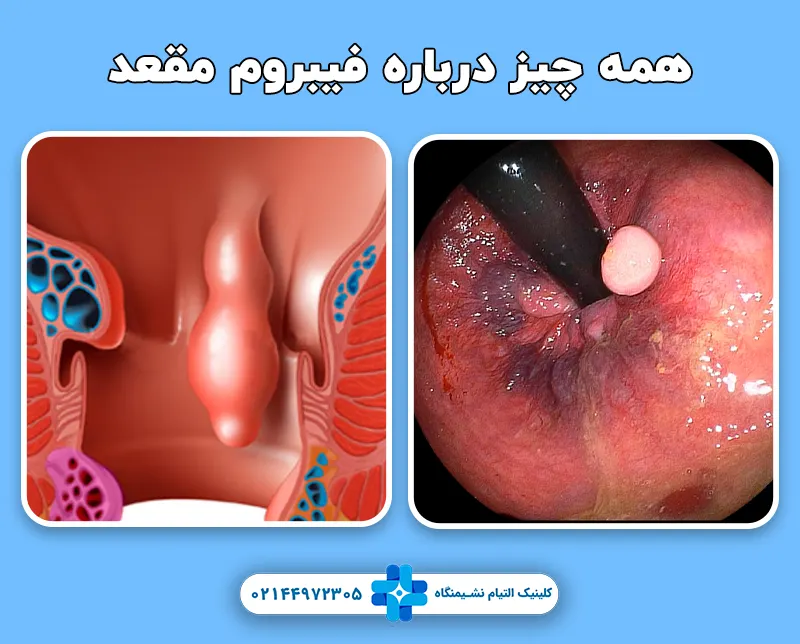 فیبروم مقعد