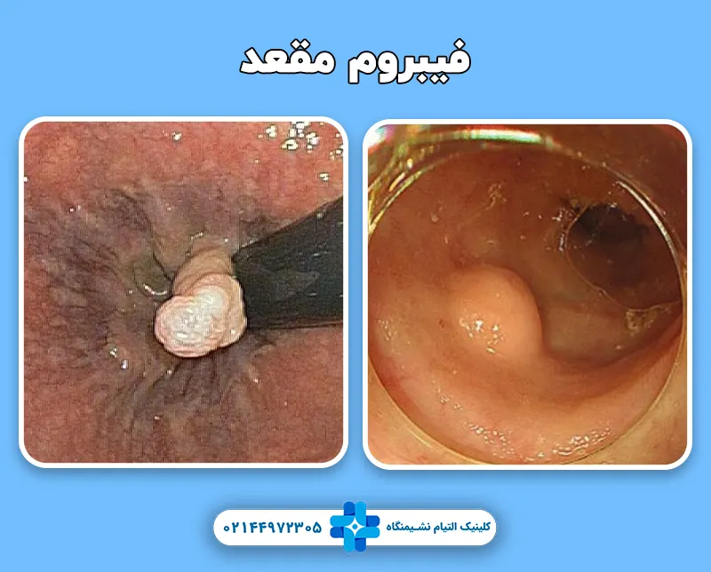 فیبروم مقعد