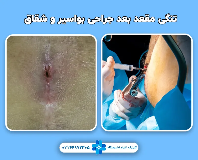 تنگی مقعد بعد جراحی بواسیر و شقاق