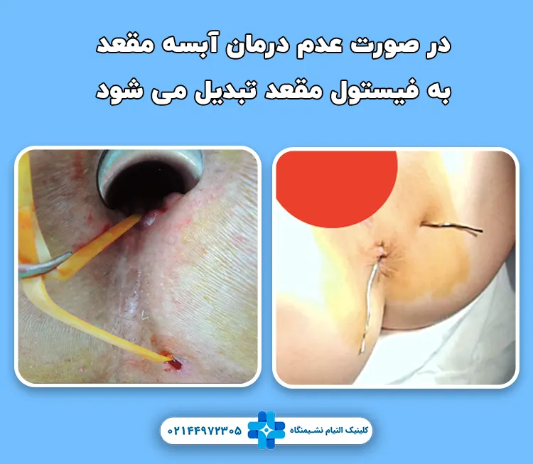 تبدیل آبسه به فیستول مقعد