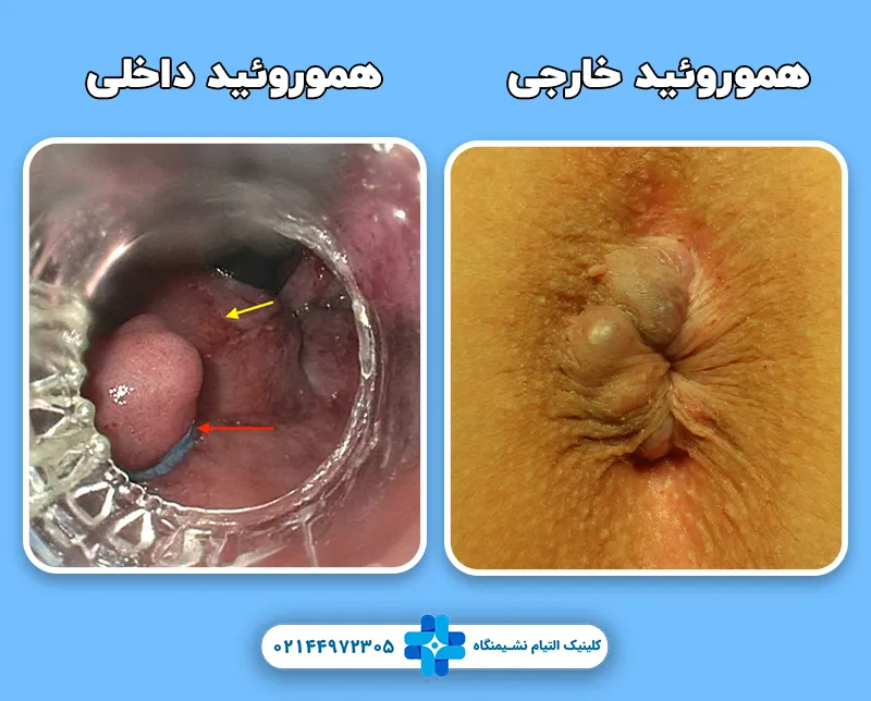 تفاوت هموروئید داخلی و خارجی