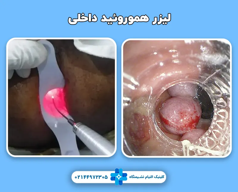 لیزر co2 هموروئید داخلی