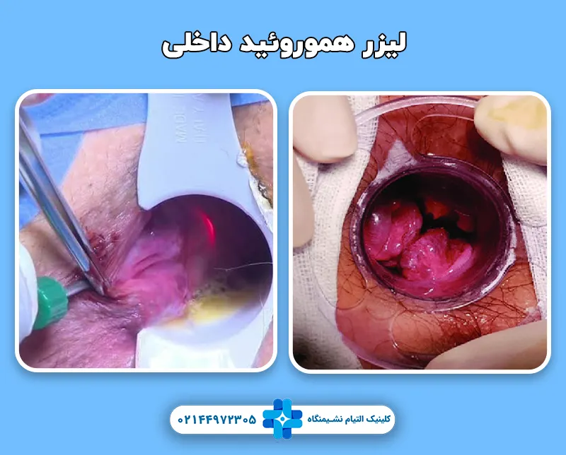 لیزر هموروئید داخلی