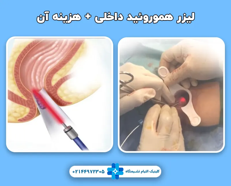 لیزر هموروئید داخلی 