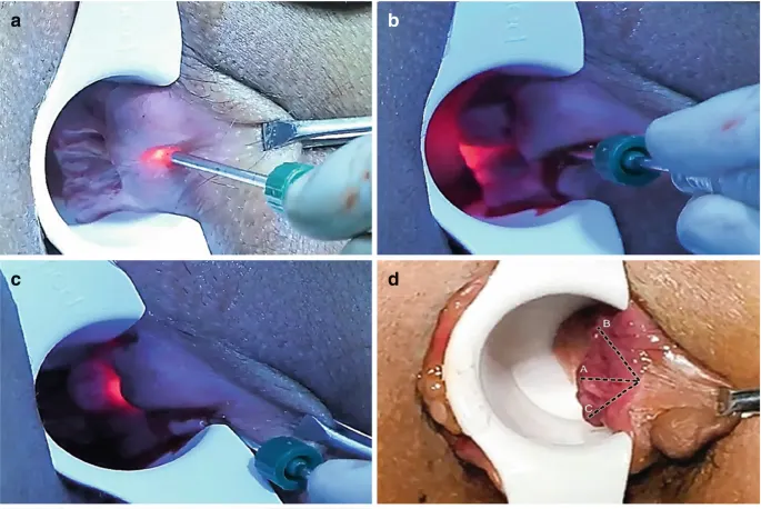 هموروئید داخلی