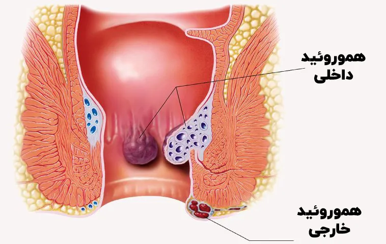هموروئید داخلی