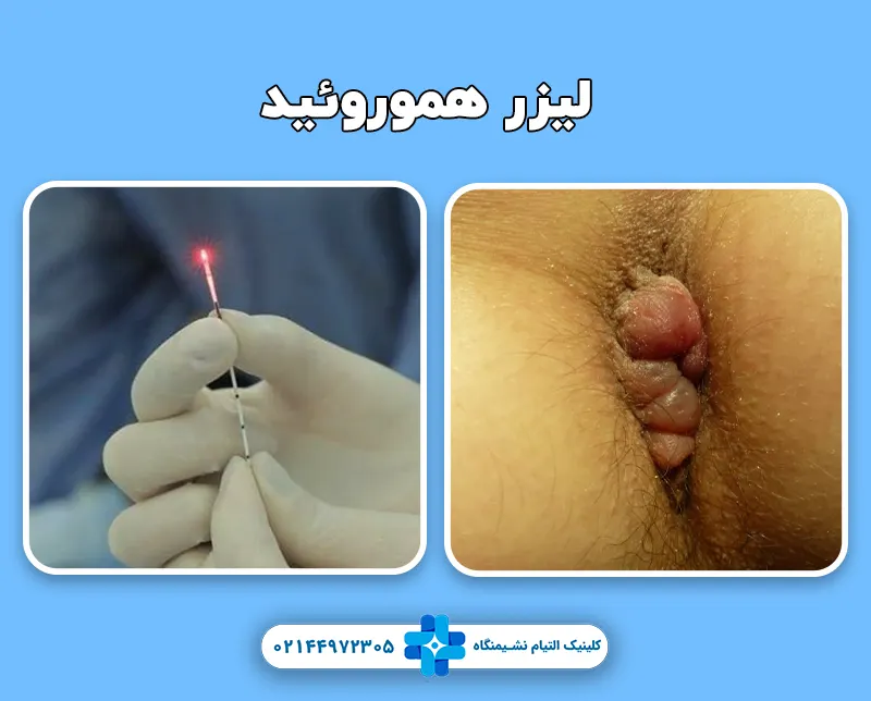 لیزر همورئید