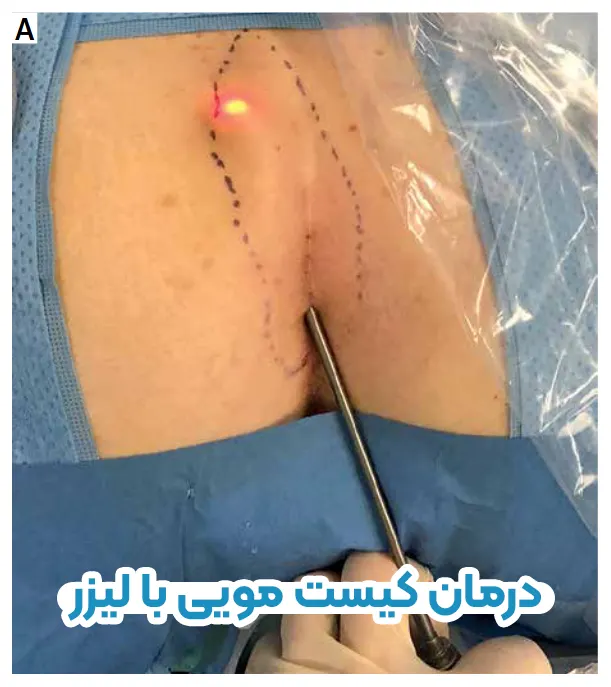 لیزر کیست مویی