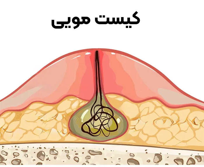 کیست مویی
